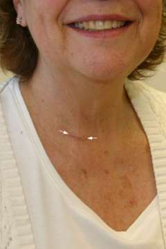 Scar after parathyroidectomy