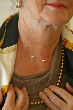 3 months after surgery