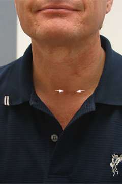 3 months after surgery