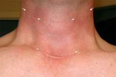 Scar appearance 1 year after radical surgery for metastatic thyroid cancer