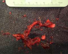 ST - The clot removed from the sinus