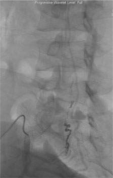 Two feeding arteries harboring the aneurysms were obliterated using catheter embolization techniques.