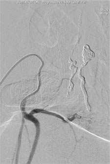 The aneurysms were completely obliterated, and the risk of bleeding was reduced. However the AVM receives blood flow from the other feeding arteries.