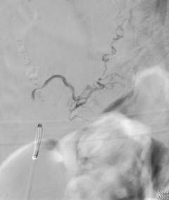 A microcatheter was navigated into a spinal dural AVF.