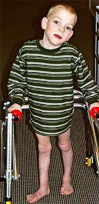 Child with cerebral palsy using crutches to stand