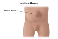 Figure showing the appearance of an umbilical hernia