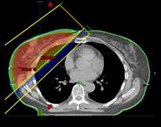 Fig. 1: Whole breast radiation therapy