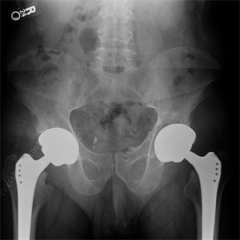 xray showing hips that have undergone joint replacement.
