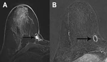 Breast MRI Findings: Post-surgical Findings Seroma