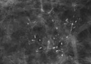 Fine Linear Calcifications