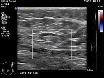 Case: Axillary Lymphadenopathy  Figure 2