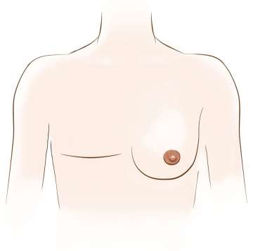 Illustration of woman with one breast and mastectomy scar