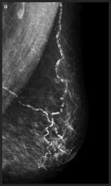 Vascular calcifications