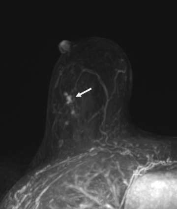 Case: Ductal Carcinoma In Situ Figure 2
