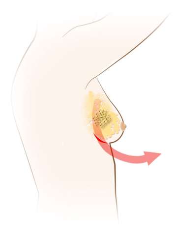 Illustrated diagram of a incision point in the breast for a inframammary fold.