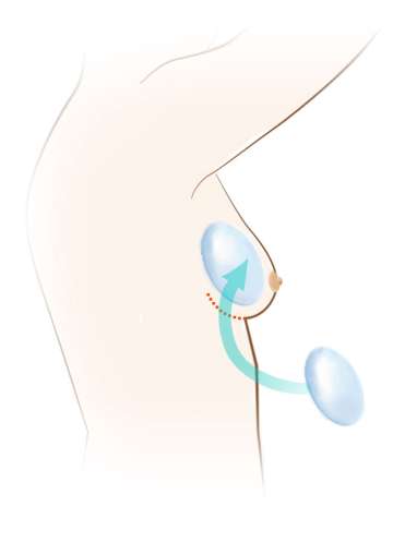 Diagram of breast reconstruction using inframammary fold incision