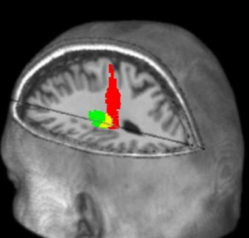 An illustration of a human head cross section with a part of the brain visible, mostly monochrome but with one section of brain showing green, yellow, and a column of red