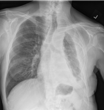 Chest X-ray showing a large fluid buildup around the left lung, which can be caused by mesothelioma and may lead to breathing difficulty.