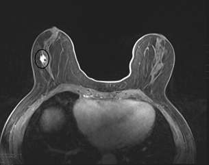 Case: Invasive Lobular Carcinoma Figure 3