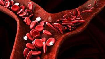 sicklecell