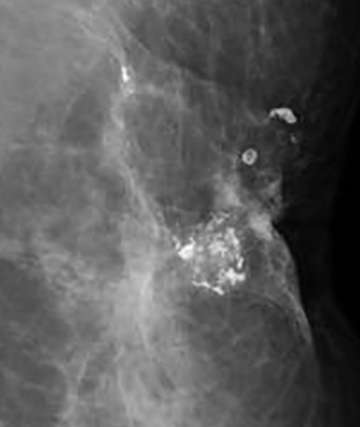 Dystrophic Calcifications