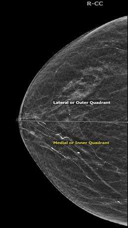 Screening Mammogram: Breast Lesion Localization Figure 3