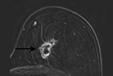 Breast MRI Findings: Post-surgical Findings Enhancing Masses