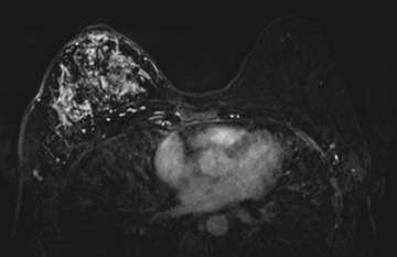 Case: Inflammatory Breast Cancer Figure 2
