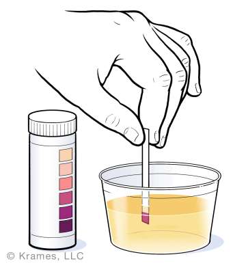 Illustration of hand inserting ketone test strip into urine in cup. Diabetes program.