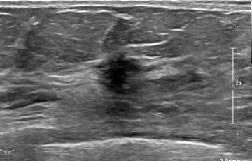 Case: Invasive Lobular Carcinoma Figure 2