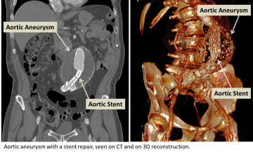 Aortic aneurysm with a stent repair seen on CT and on 3D Reconstruction