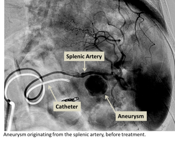 Splenic artery aneurysm before treatment