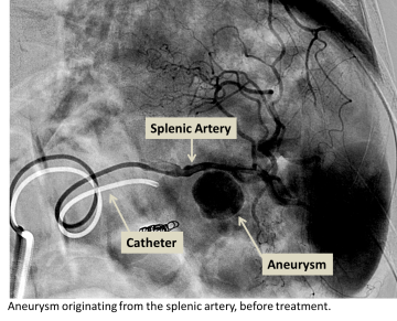 Splenic artery aneurysm before treatment