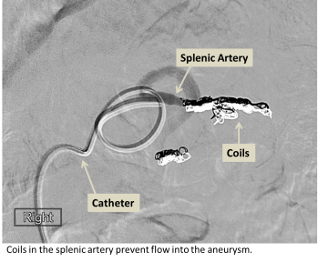 Coils in the splenic artery prevent flow into the aneurysm