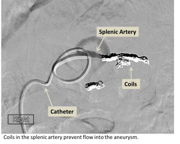 medical illustration of Coils in the splenic artery prevent flow into the aneurysm