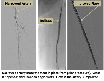 Narrowed artery. Vessel is "opened" with balloon angioplasty. Flow in the artery is improved