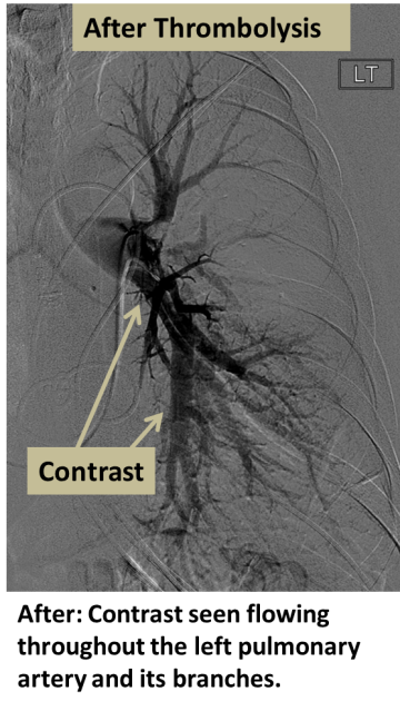After: Contrast seen flowing throughout the left pulmonary artery and its branches