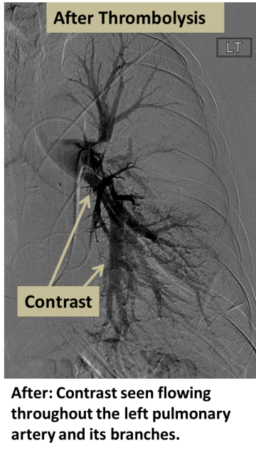 After: Contrast seen flowing throughout the left pulmonary artery and its branches