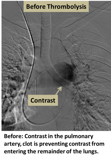 Before: Contrast in the pulmonary artery, clot is preventing contrast from entering the remainder of the lungs