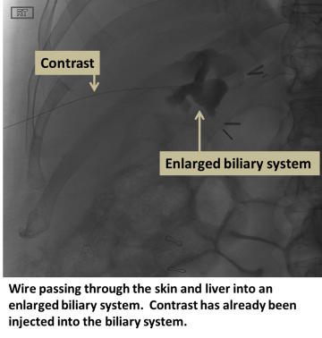 Wire passing thru the skin and liver into an enlarged biliary system. Contrast already injected into biliary system
