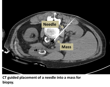 CT guided placement of a needle into a mass for biopsy
