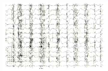 Seizure EEG