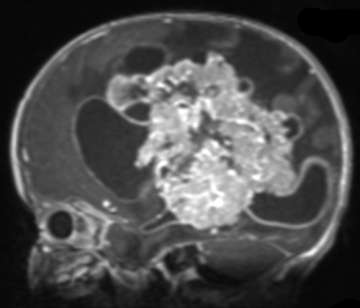 Image of Choroid Plexus Tumor