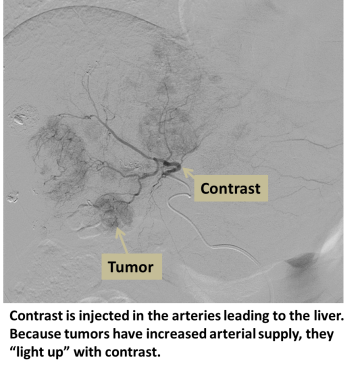 Contrast injected in arteries leading to the liver. Because tumors have increased arterial supply, they light up with contrast