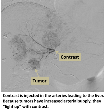 Contrast injected in arteries leading to the liver. Because tumors have increased arterial supply, they light up with contrast