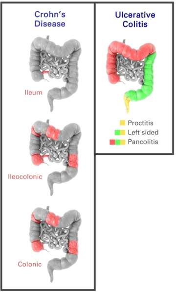 Image of different areas of the intestines that are affected by Crohn's Disease & Ulcerative Colitis
