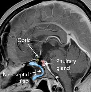 Cranio Sag After Surgery