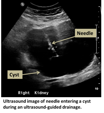 Ultrasound image of needle entering a cyst during an ultrasound-guided drainage