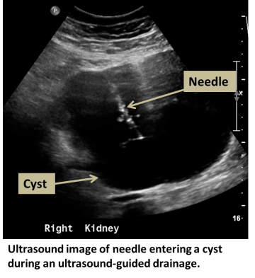 Ultrasound image of needle entering a cyst during an ultrasound-guided drainage