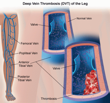 Deep Vein Thrombosis of the Leg